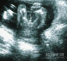 تشخیص اشتباه جنسیت جنین پسر