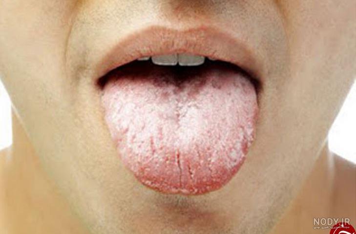علت سفید شدن زبان در طب سنتی روازاده