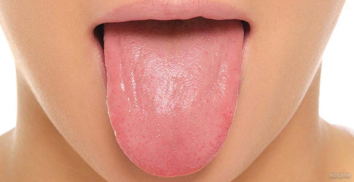 علت سفیدی زبان در بزرگسالان چیست