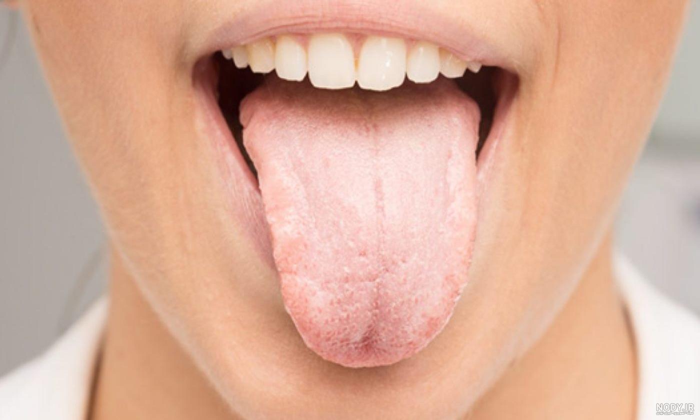 علت سفیدی زبان در طب سنتی
