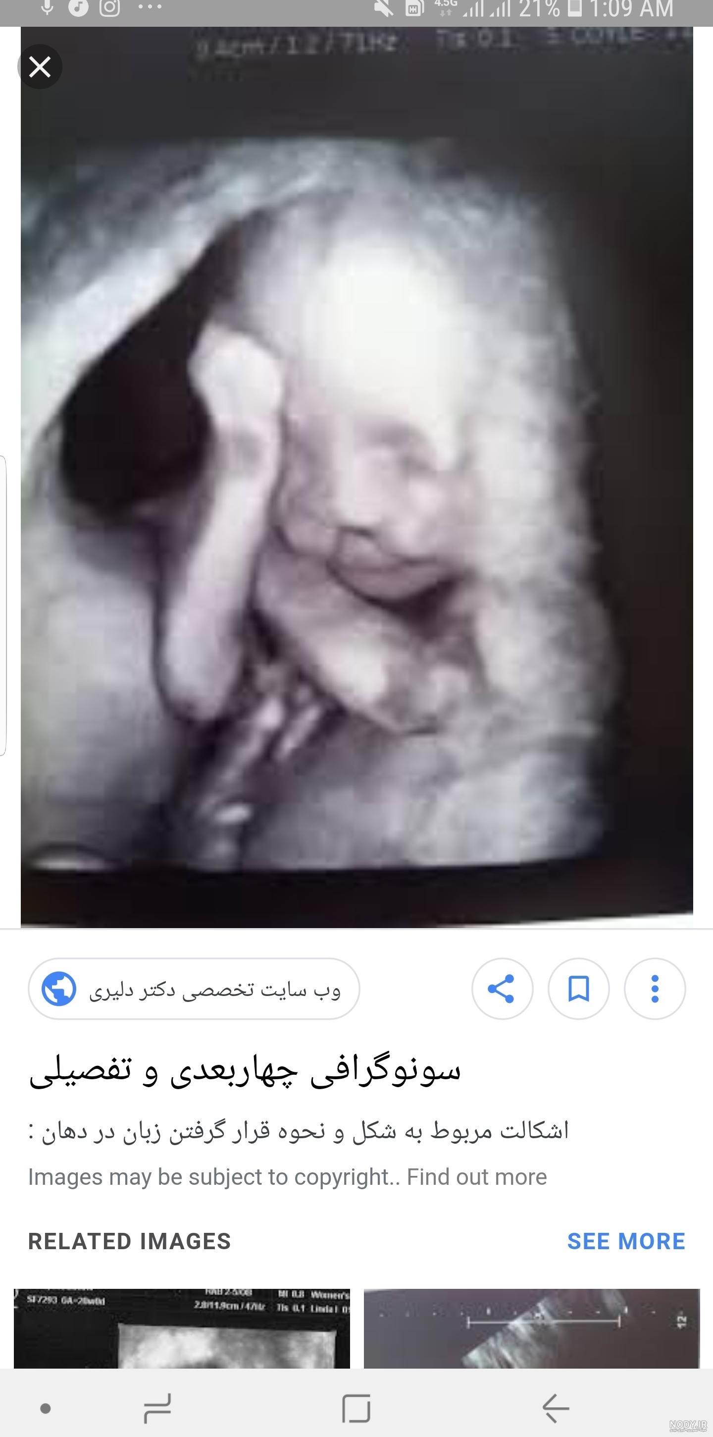 عکس سونوگرافی جنین نی نی سایت عکس سونوگرافی جنین نی نی سایت