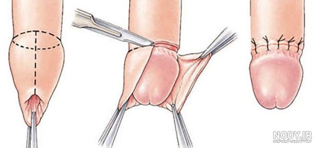 عکس زیاد بریدن پوست در ختنه