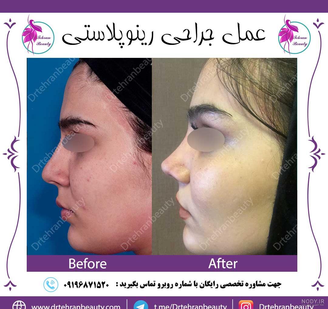 سی تی اسکن بینی