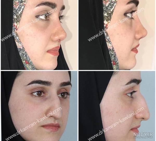 عکس شیلا خداداد قبل جراحی بینی