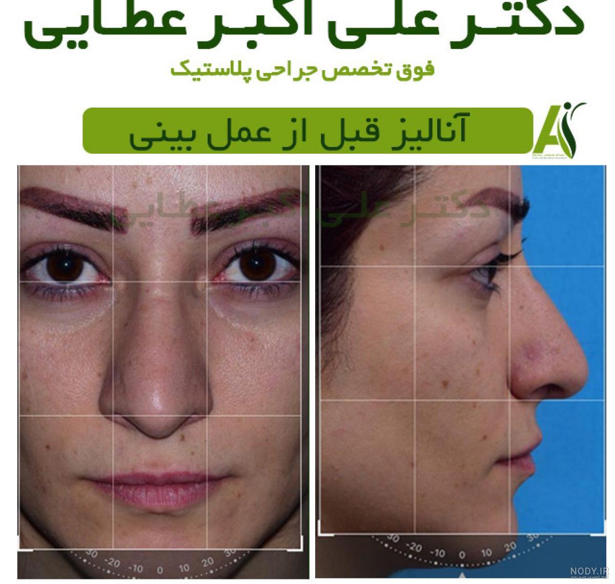 عکس قبل از جراحی بینی