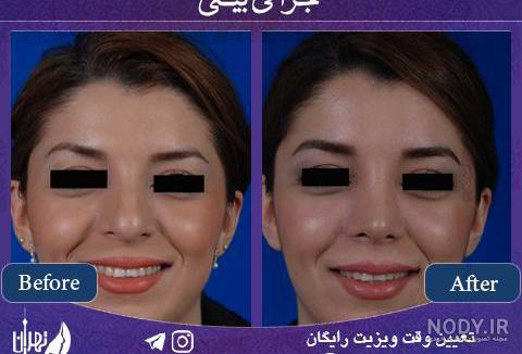 عکس قبل و بعد از عمل جراحی بینی