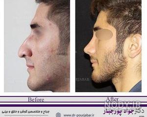 عکس قبل و بعد از عمل جراحی بینی نیوشا ضیغمی