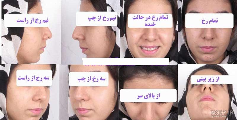 عکس قبل و بعد جراحی بینی