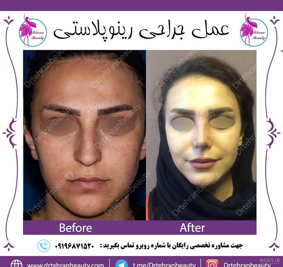 عکس قبل و بعد جراحی بینی گوشتی
