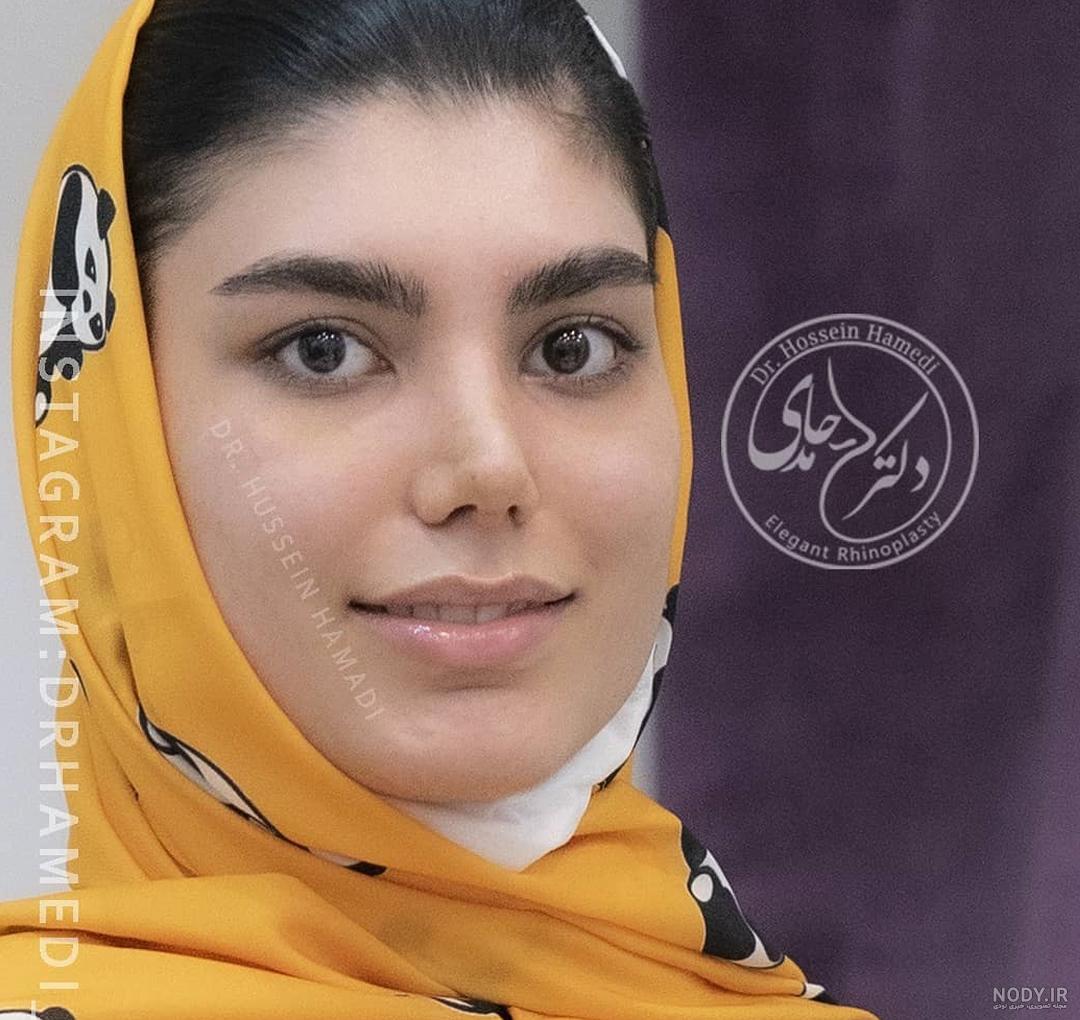 عکس قبل و بعد عمل جراحی بینی