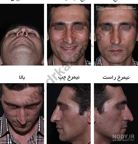 عکس قبل وبعد از جراحی بینی