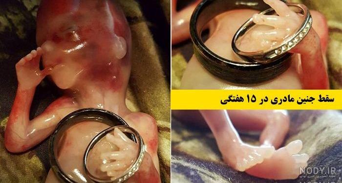 عکس لکه بینی در دوران بارداری