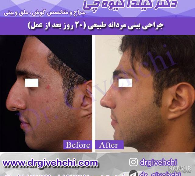 عکس مهستی قبل از جراحی بینی