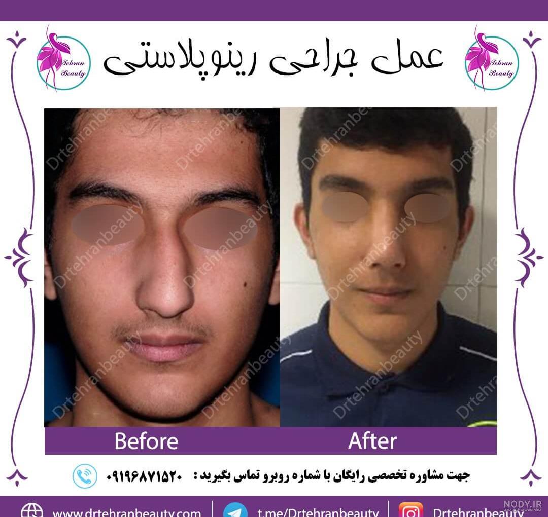 عکس نیوشا ضیغمی قبل جراحی بینی