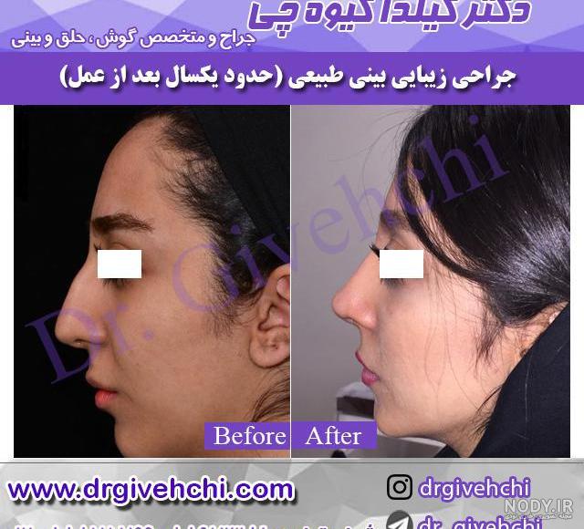 قیمت سی تی اسکن برای عمل بینی