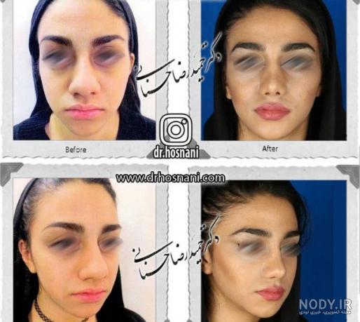 قیمت عکس بینی برای عمل