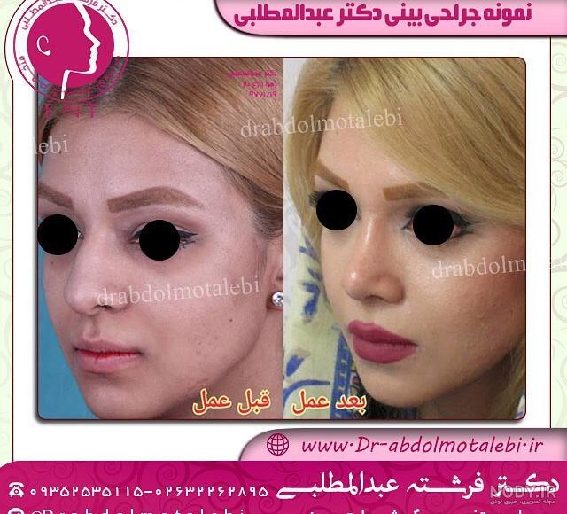 مراحل عمل بینی استخوانی