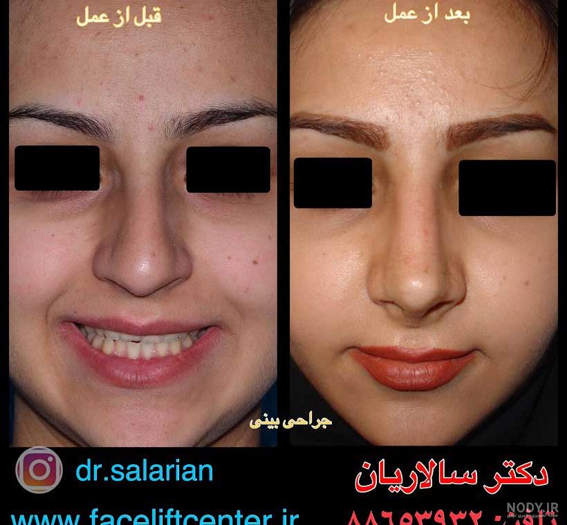 هزینه فتوگرافی بینی