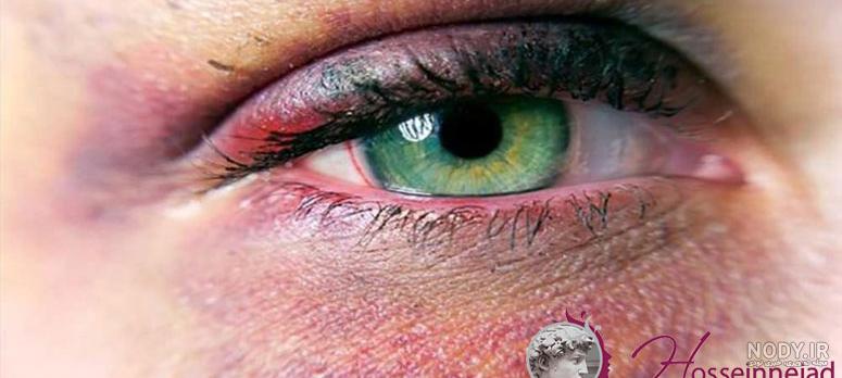 درمان سریع سیاهی دور چشم