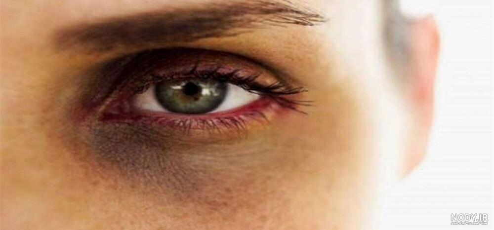 درمان سیاهی دور چشم با لیزر