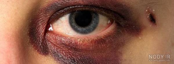رفع کبودی زیر چشم بعد از عمل بینی