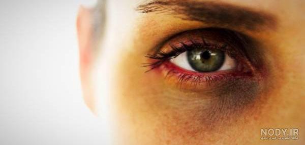 رفع کبودی زیر چشم در اثر ضربه