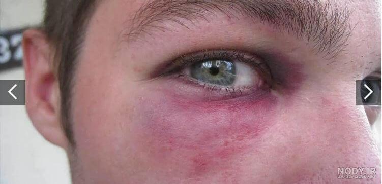 کبودی پلک بالای چشم