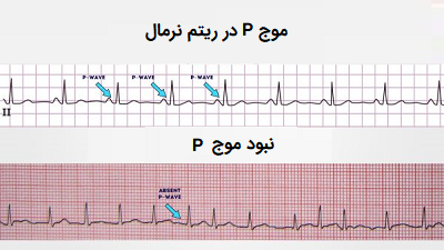 ضربان قلب بالای ۱۲۰