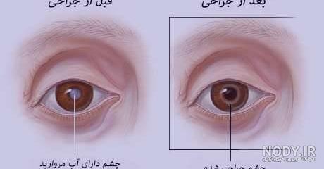 درمان آب سیاه چشم در طب سنتی درمان آب سیاه چشم در طب سنتی