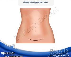 عکس عمل مینی ابدو