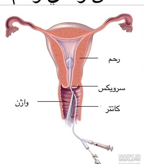 عکس رنگی رحم با بی حسی نی نی سایت