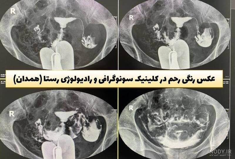 عکس رنگی رحم بهساز طب نی نی سایت