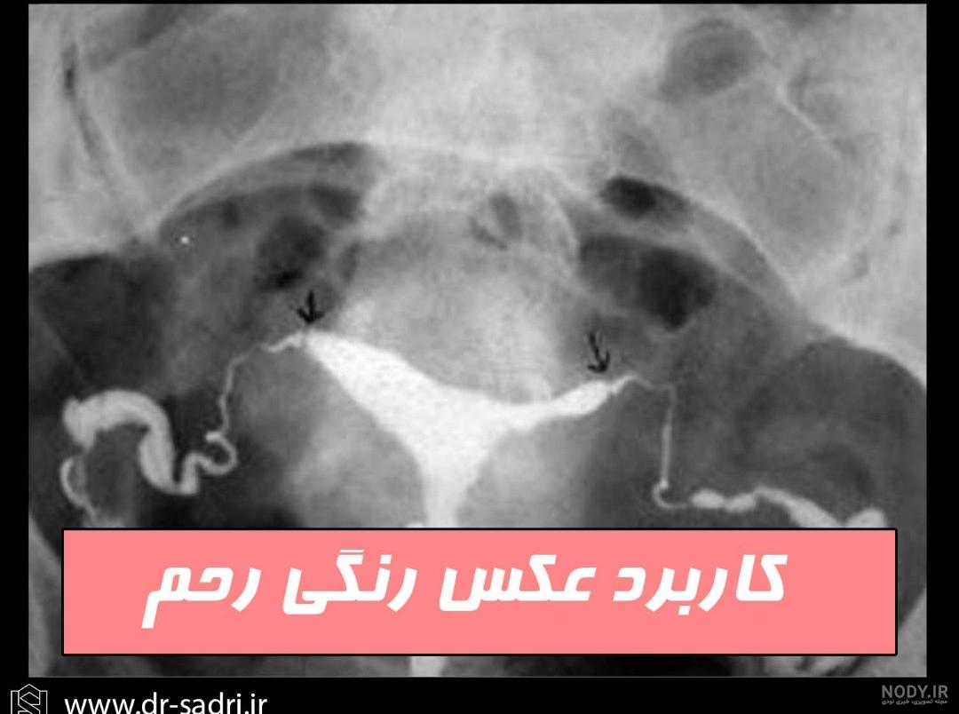 عکس رنگی رحم کرمانشاه نی نی سایت