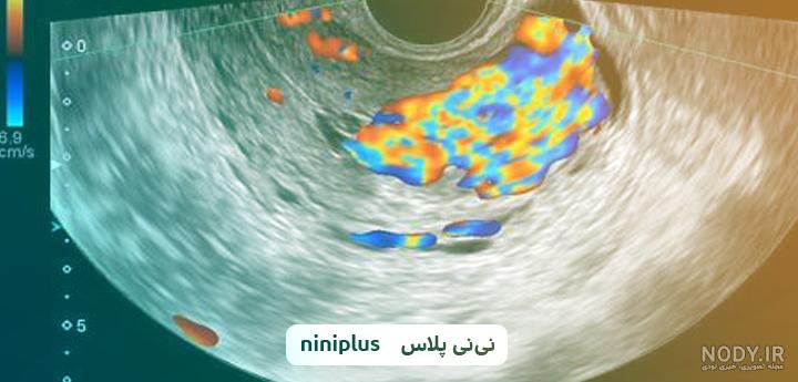 قیمت عکس رنگی رحم سال ۹۹ نی نی سایت