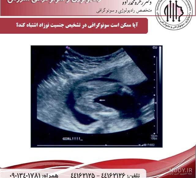 تفاوت جمجمه جنین دختر و پسر در سونوگرافی هفته 12
