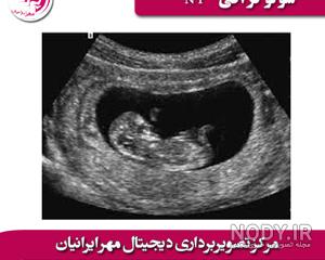 تفاوت جنین دختر و پسر در رحم