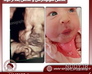 تفاوت ضربان قلب جنین دختر و پسر