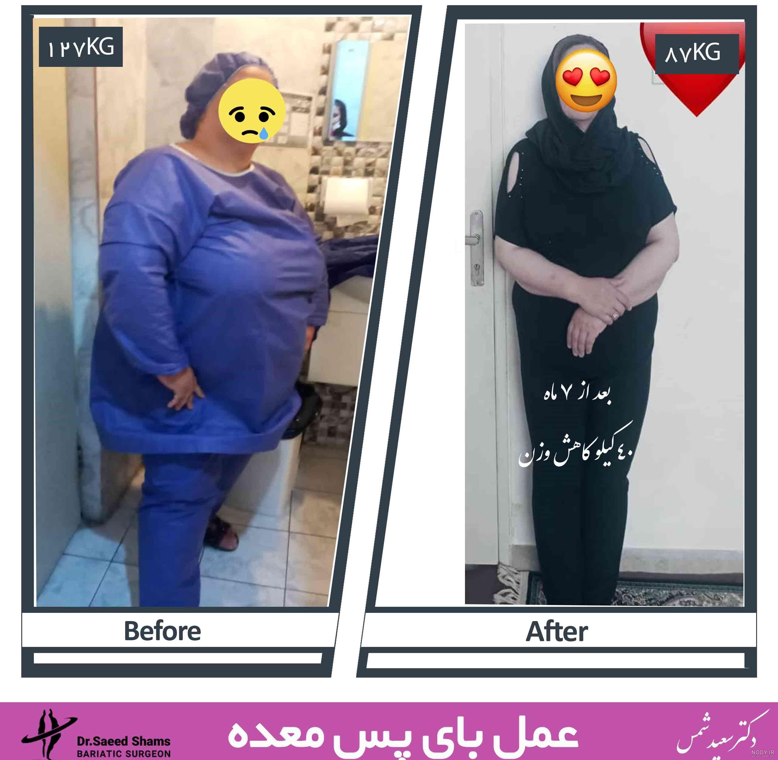 عکس قبل بعد لاغری