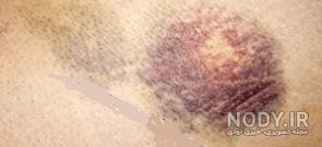 شکستگی دنده نی نی سایت شکستگی دنده نی نی سایت