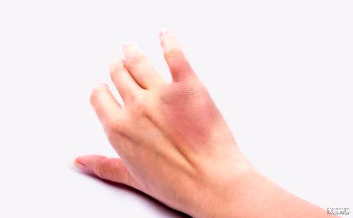 علت کبودی مچ دست