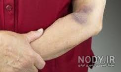 عکس کبودی پای زن عکس کبودی پای زن