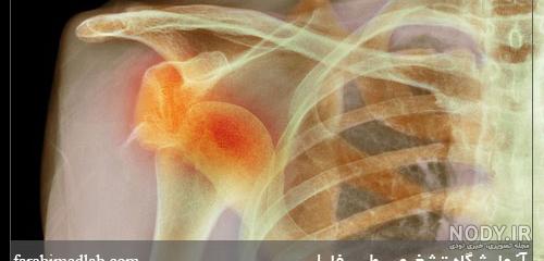 چسب شکستگی دنده چسب شکستگی دنده