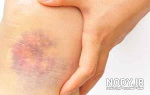چگونه بدن را کبود کنیم چگونه بدن را کبود کنیم
