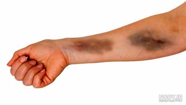 چگونه پوست را کبود کنیم نی نی سایت