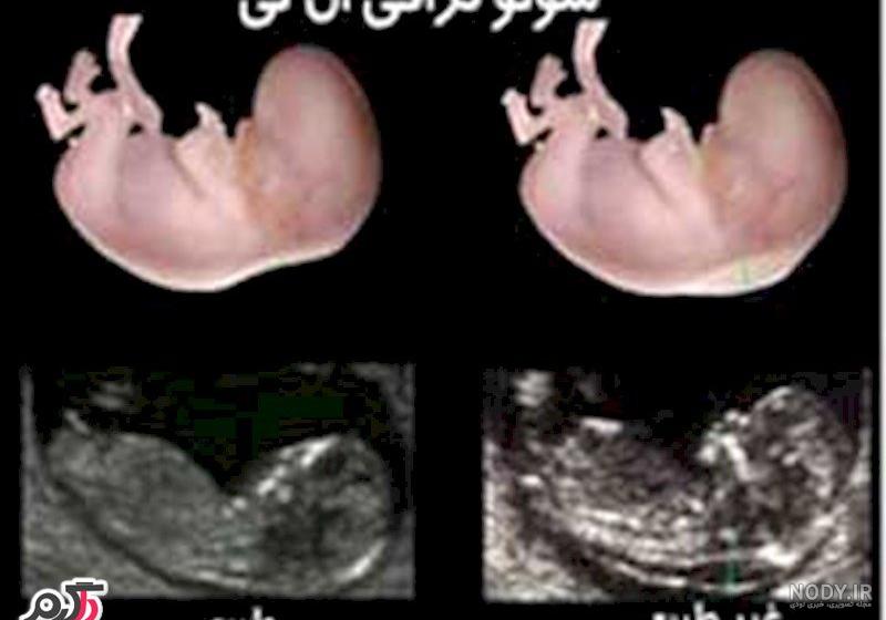 تفسیر آزمایش phe نوزادان تفسیر آزمایش phe نوزادان