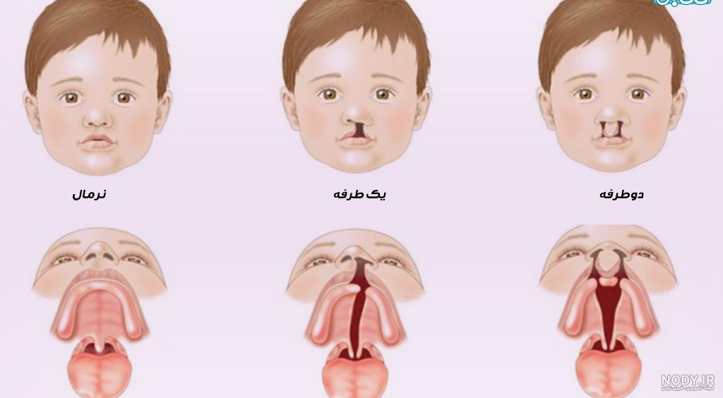خال مادرزادی نشانه چیست خال مادرزادی نشانه چیست