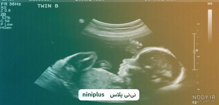 عکس جنین دختر سه ماهه عکس جنین دختر سه ماهه