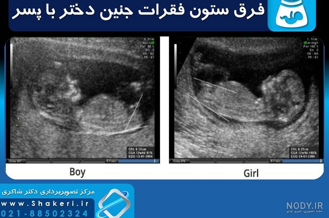 عکس جنین پسر در سه ماه اول عکس جنین پسر در سه ماه اول