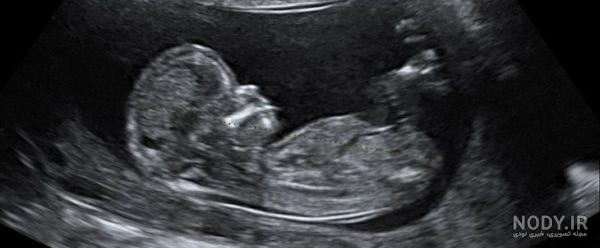 عکس سونوگرافی جنین یک هفته عکس سونوگرافی جنین یک هفته