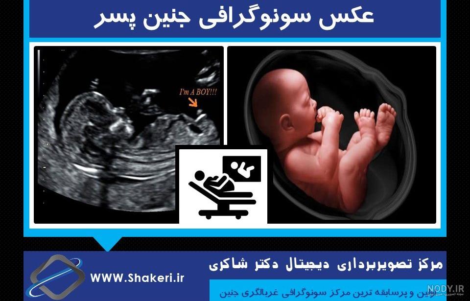 عکس غربالگری نوزاد